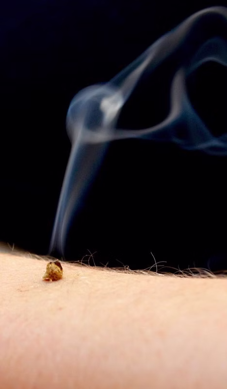 Acupuncture FAQs - Johnny Childs Leading Acupuncturist London